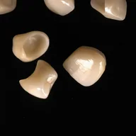 Layered ceramic crowns made by Prime Lab Dental Studios