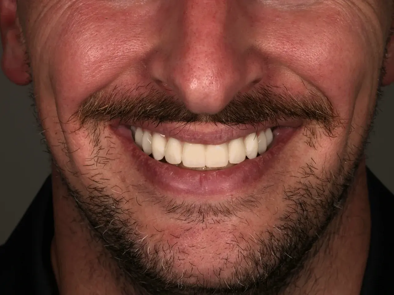 Anterior ceramic restorations by Prime Lab Dental Studios in place in a patient's smile