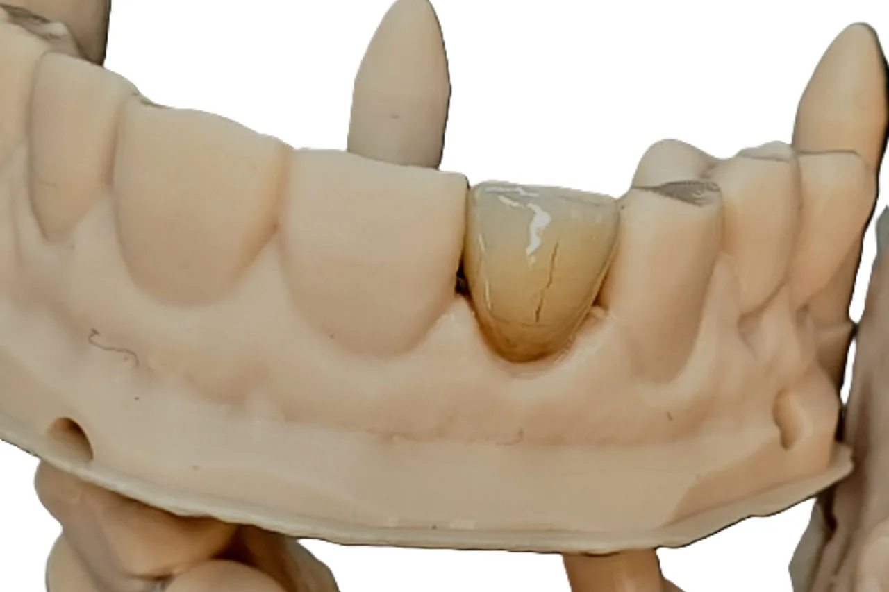Multi-layered E.max lateral incisor crown in a custom shade by Prime Lab Dental Studios