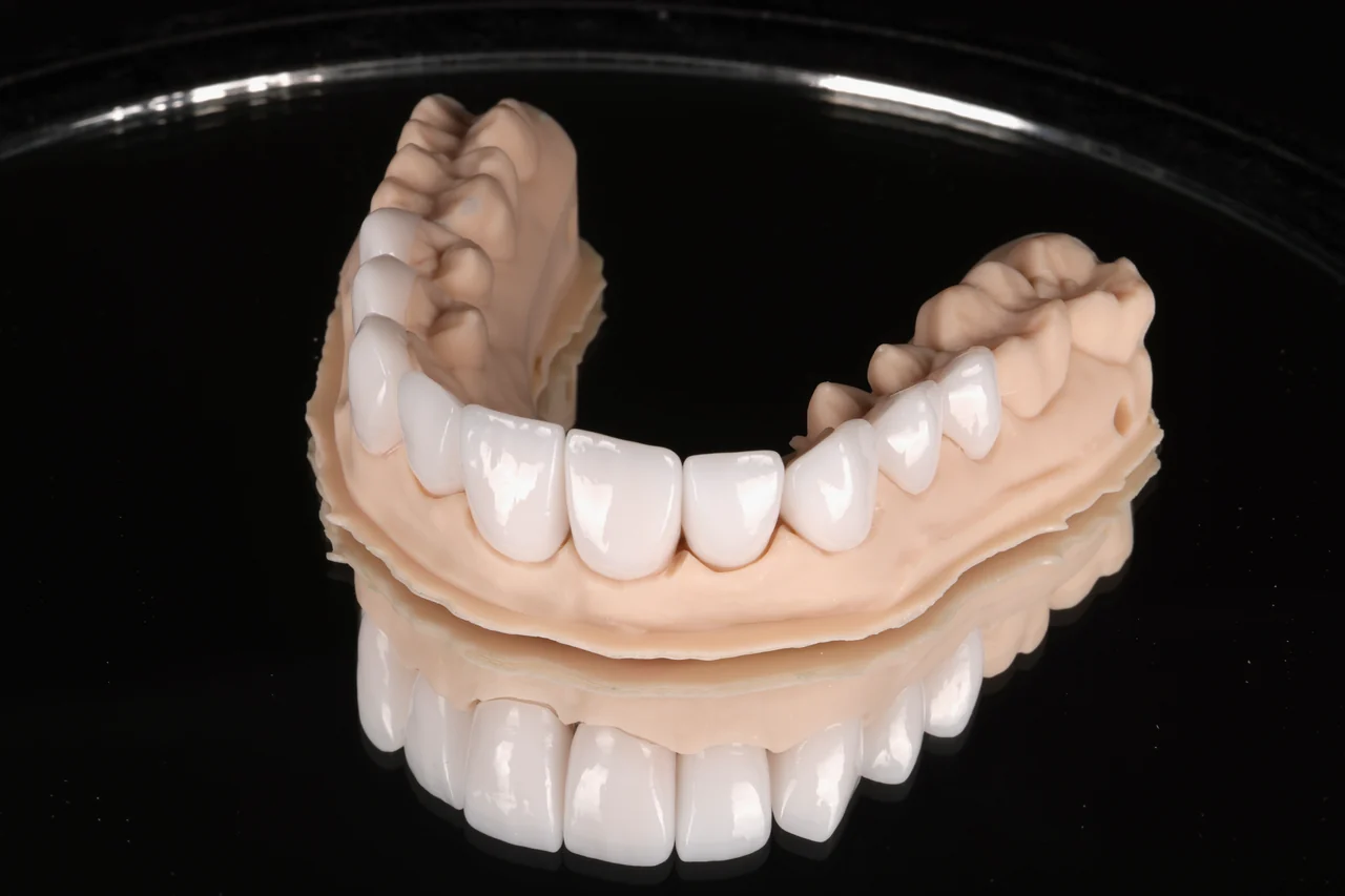 Anterior all-ceramic crowns for a smile makeover case by Prime Lab Dental Studios