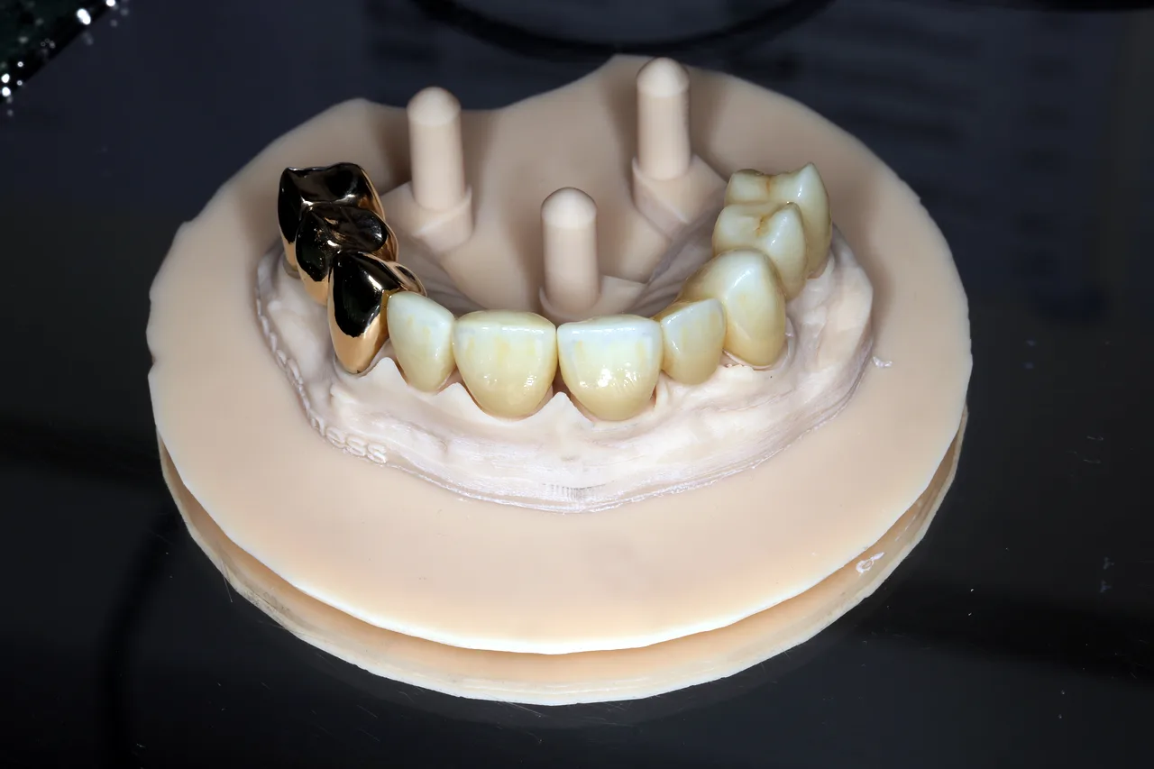 Monolithic zirconia crowns and bridge with micro-layering beside a gold bridge by Prime Lab Dental Studios
