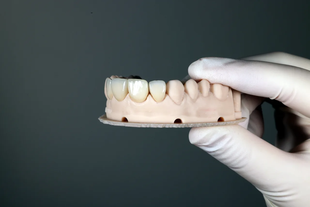 Multi-layered E.max veneers on the model by Prime Lab Dental Studios