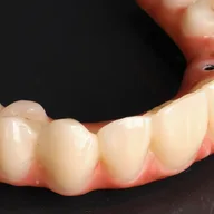 Milled digital denture made by Prime Lab Dental Studios