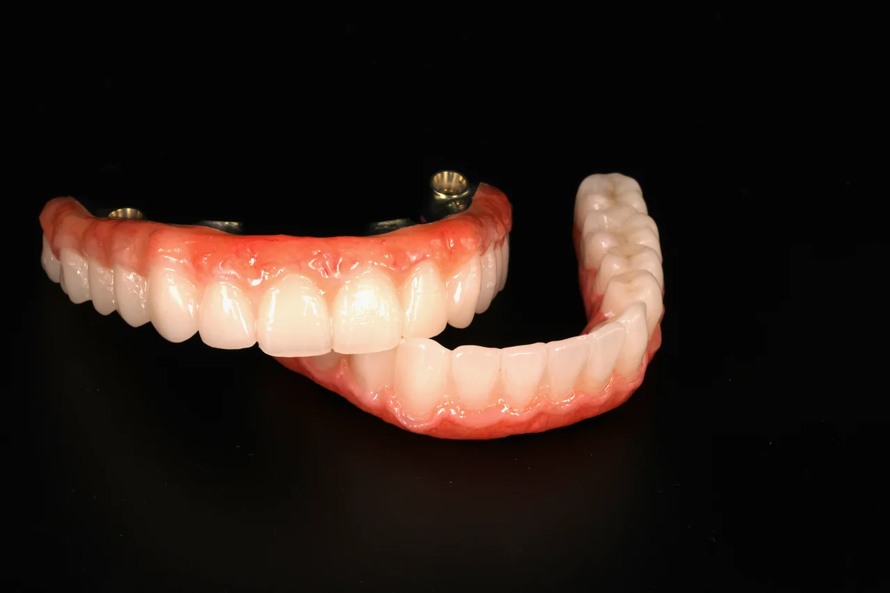 Full-arch implant case planning by Prime Lab Dental Studios