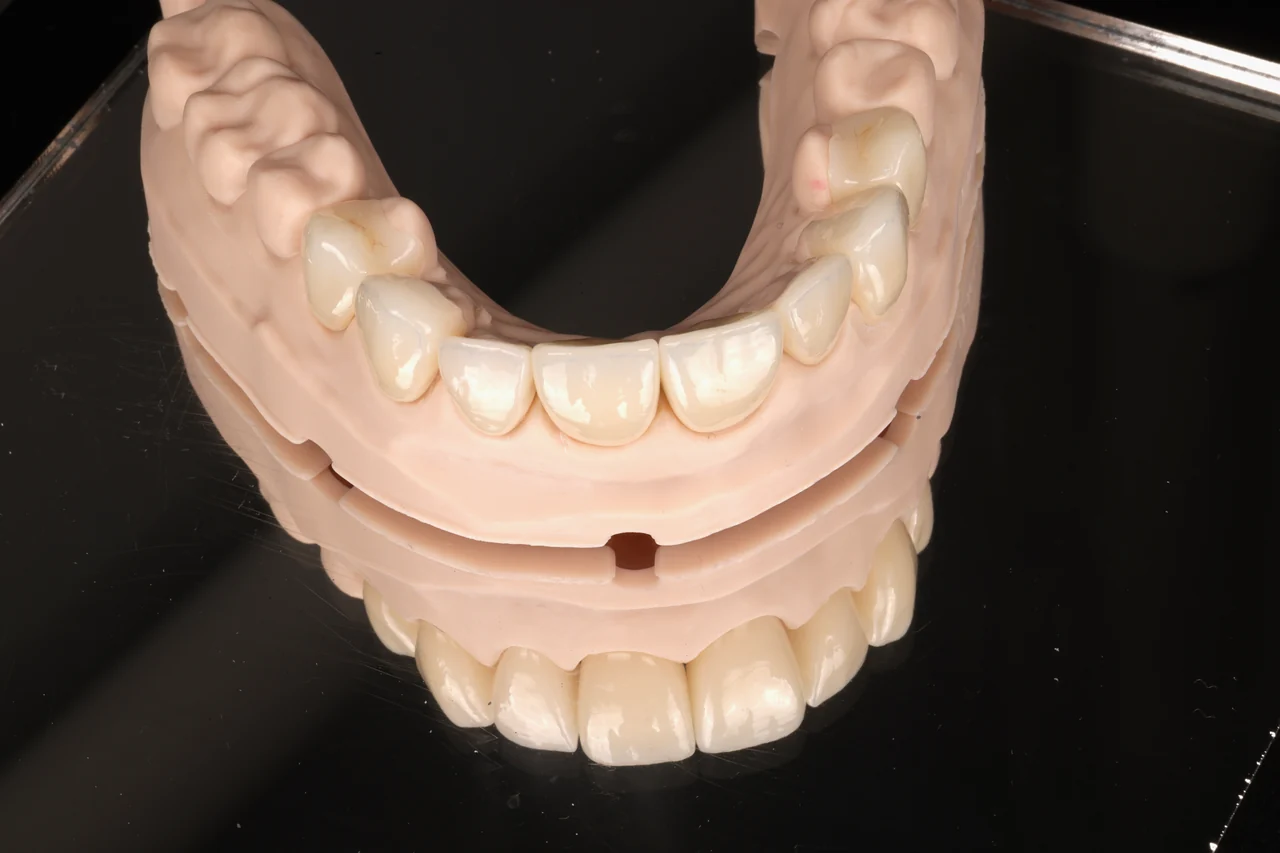 Full-arch zirconia bridge by Prime Lab Dental Studios