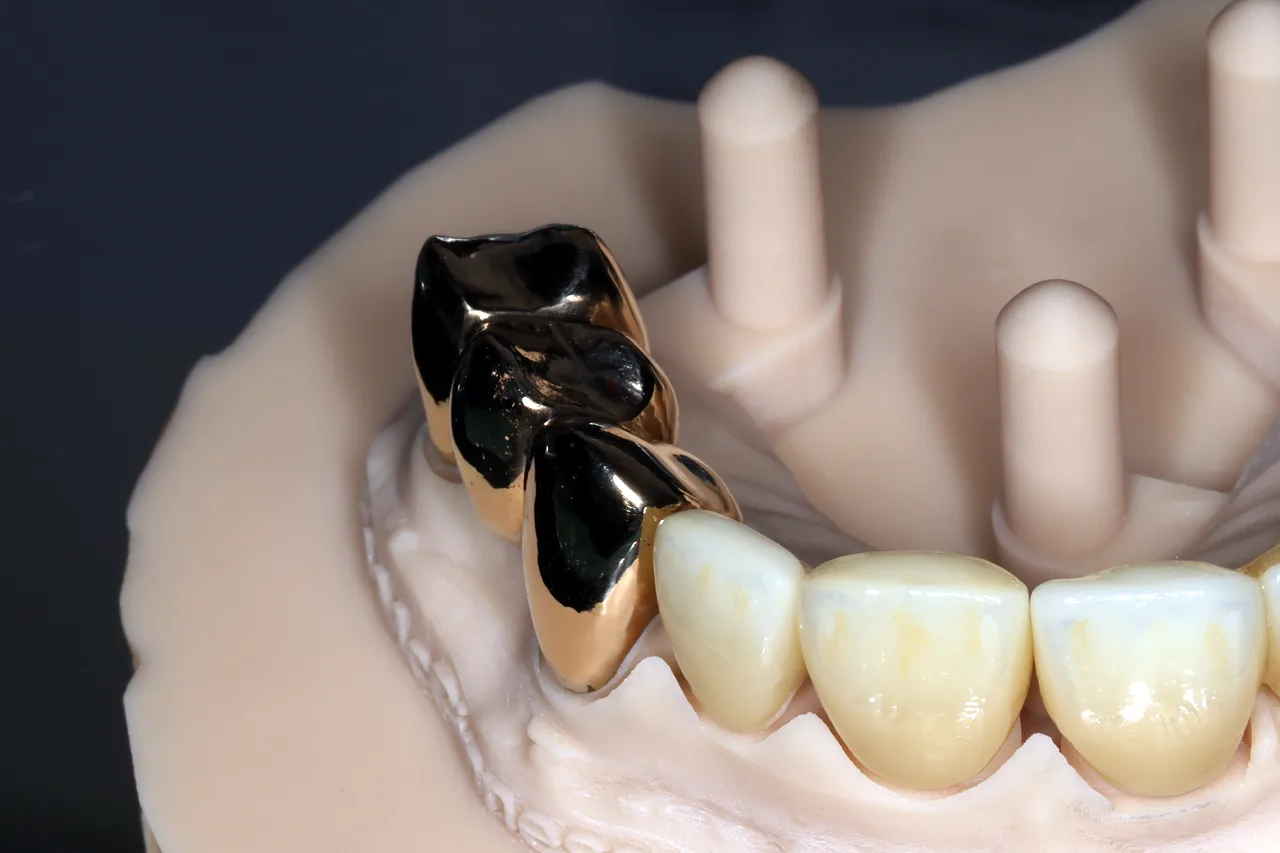 Full-cast gold bridge on a model alongside ceramic units, made by Prime Lab Dental Studios