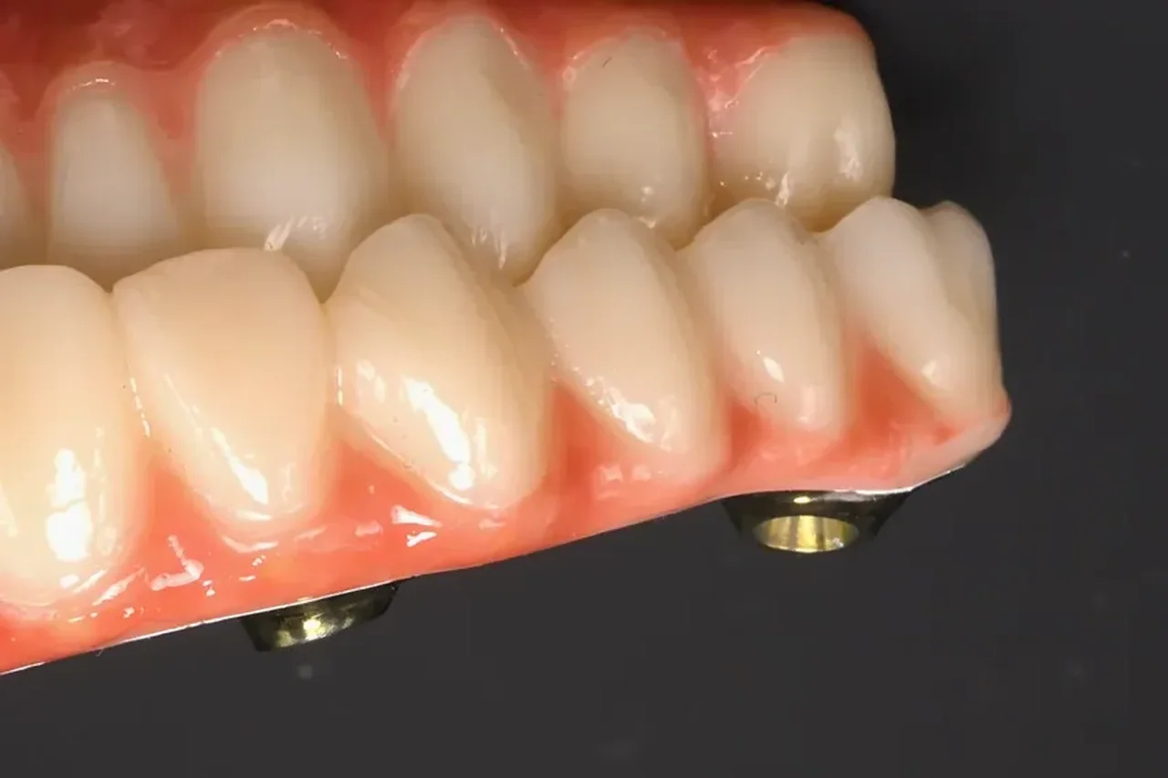 Implant crown on a custom abutment by Prime Lab Dental Studios