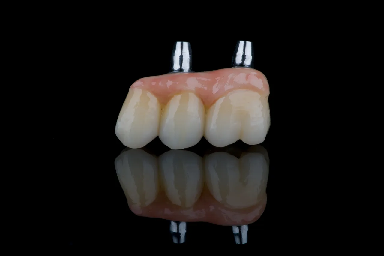 Screw-retained zirconia implant bridge on two titanium abutments