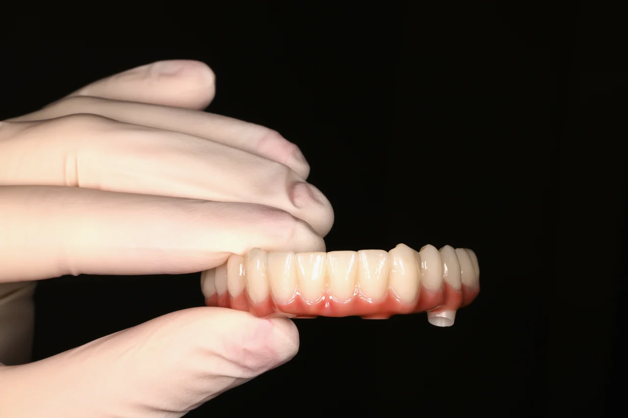 Implant-supported bridge by Prime Lab Dental Studios