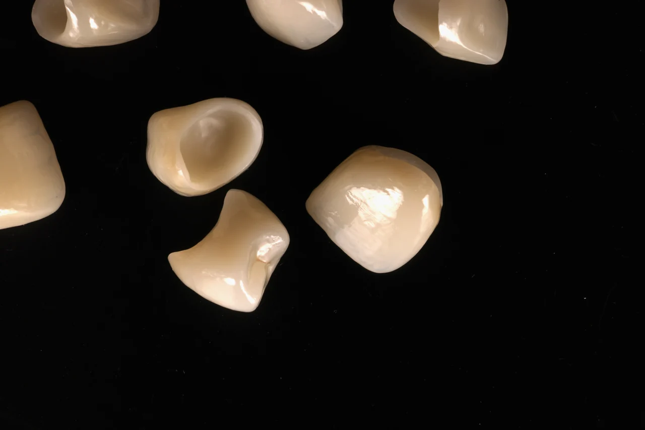 Layered ceramic crowns by Prime Lab Dental Studios