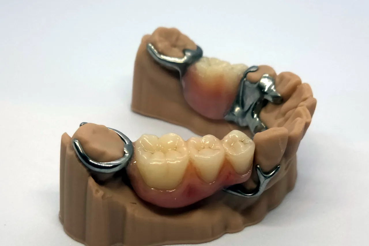 Cobalt chrome partial denture on the model by Prime Lab Dental Studios