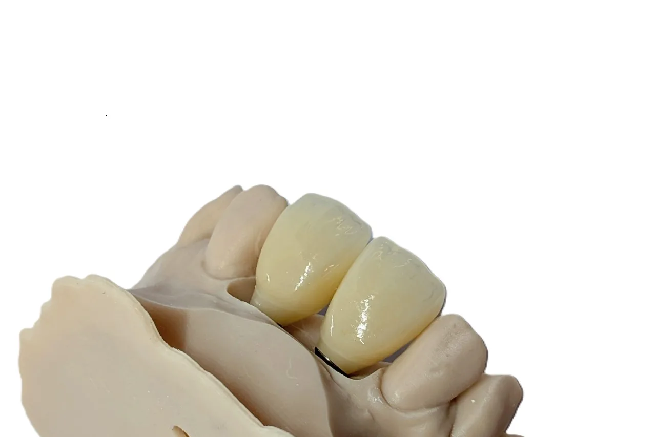 Multi-layered zirconia central implant crowns seated on the model by Prime Lab Dental Studios