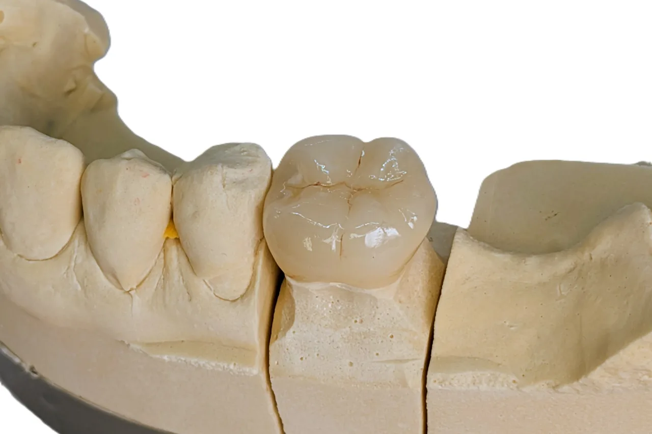 Single posterior monolithic zirconia crown by Prime Lab Dental Studios
